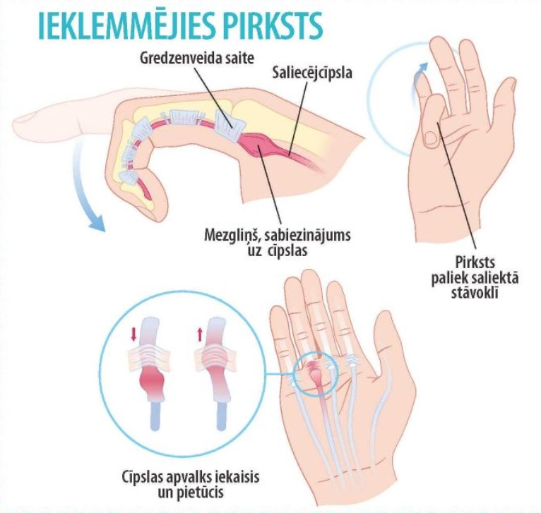 Plastikas un rokas ķirurga Ulda Krustiņa zīmējums.