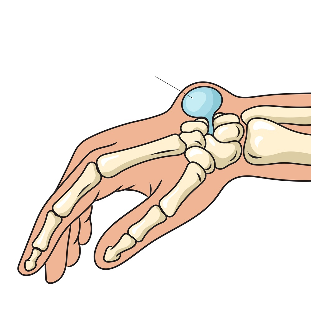 Ganglija cistas – bumbulīši uz plaukstas locītavas, plaukstas iekšpusē pie pirkstu pamatnes, pirkstu galos.