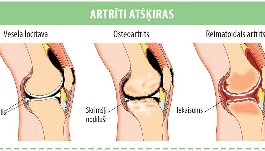 reimatoīdais artrīts dureri de genunchi la spate