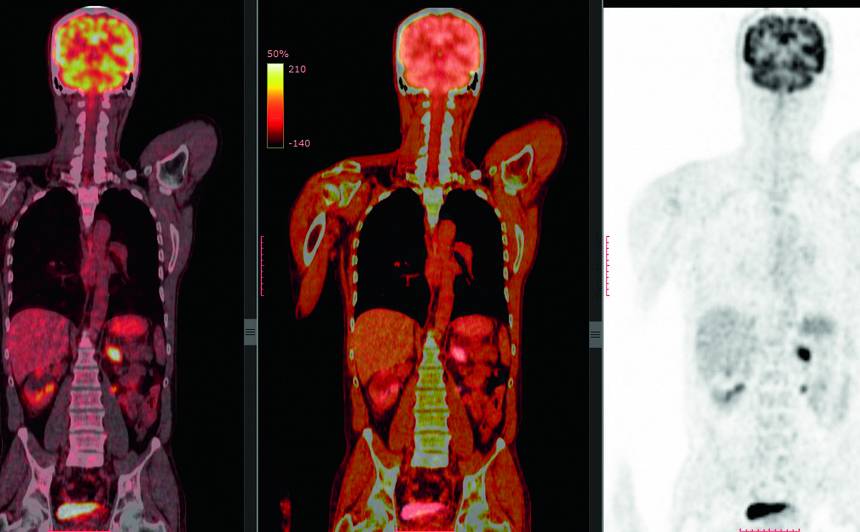 PET/CT izmeklējumā šūnas, kuras patērē visvairāk radioaktīvā cukura, spoži spīd.
