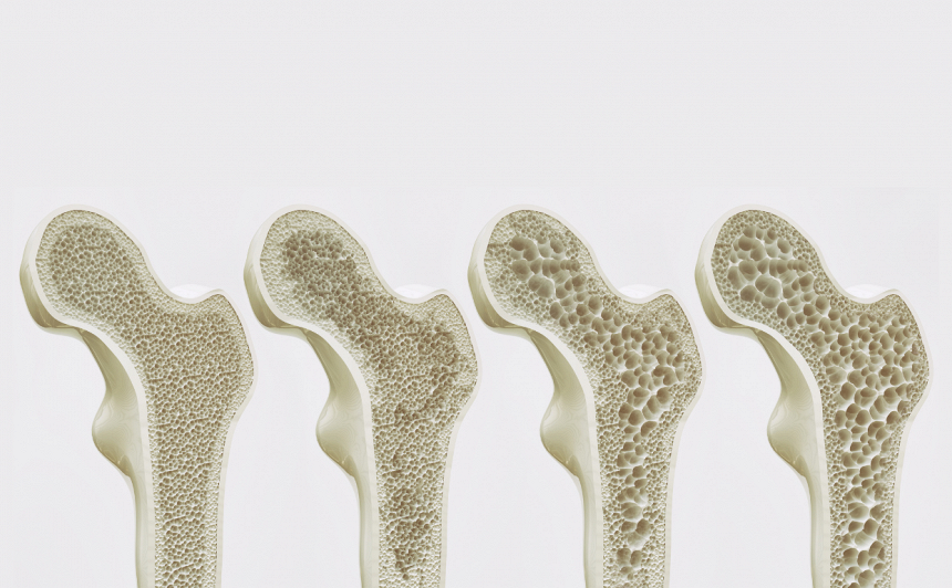 Osteoporozes stadijas – kreisajā pusē vesels kauls.